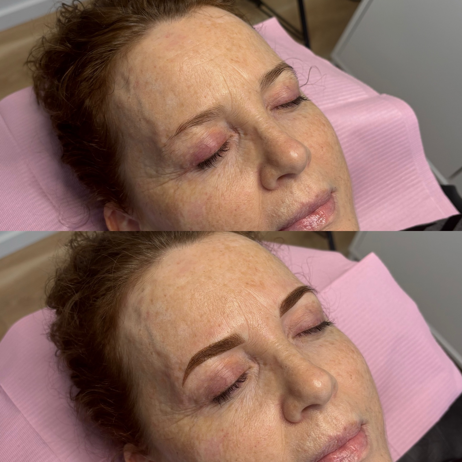 Before and after brow enhancement